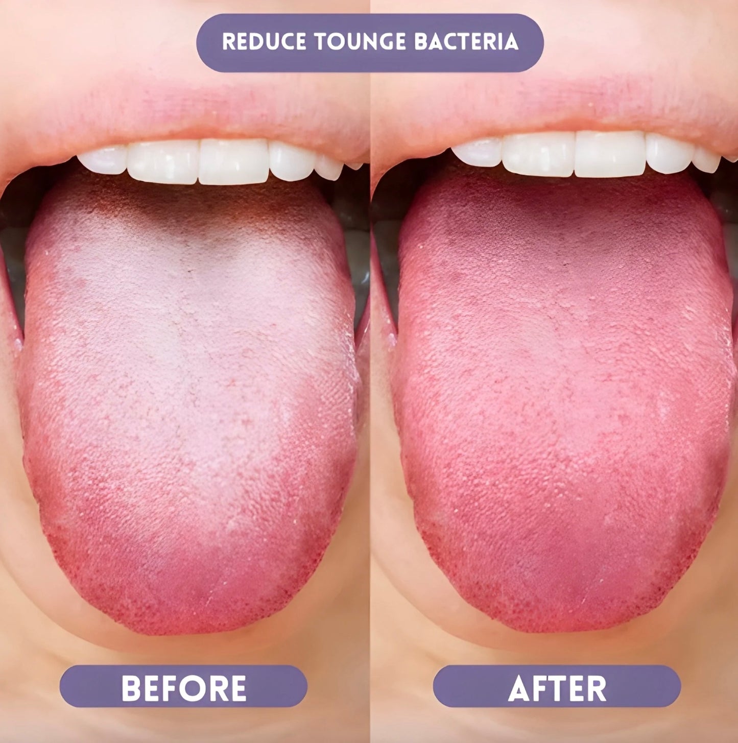 Zorinela™ Probiotic Oral Spray